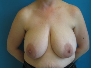 Patient before breast reduction procedure